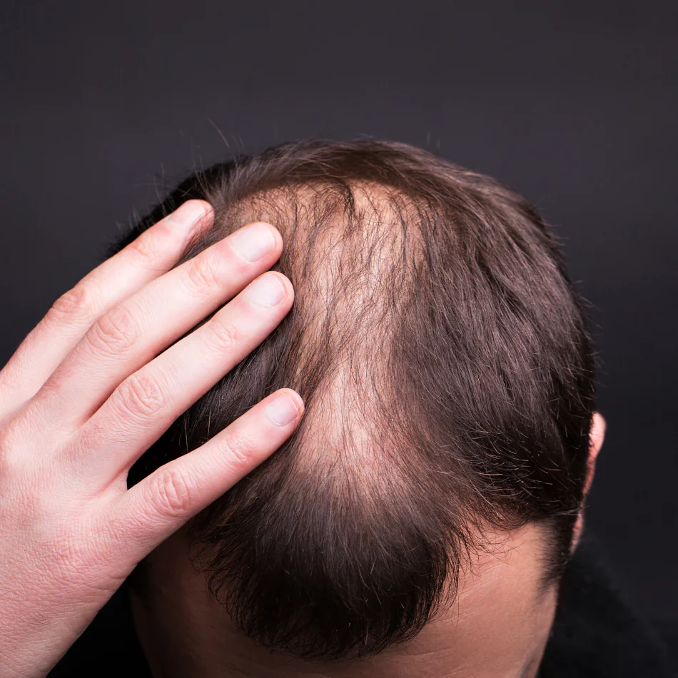 Alopecia Androgenética