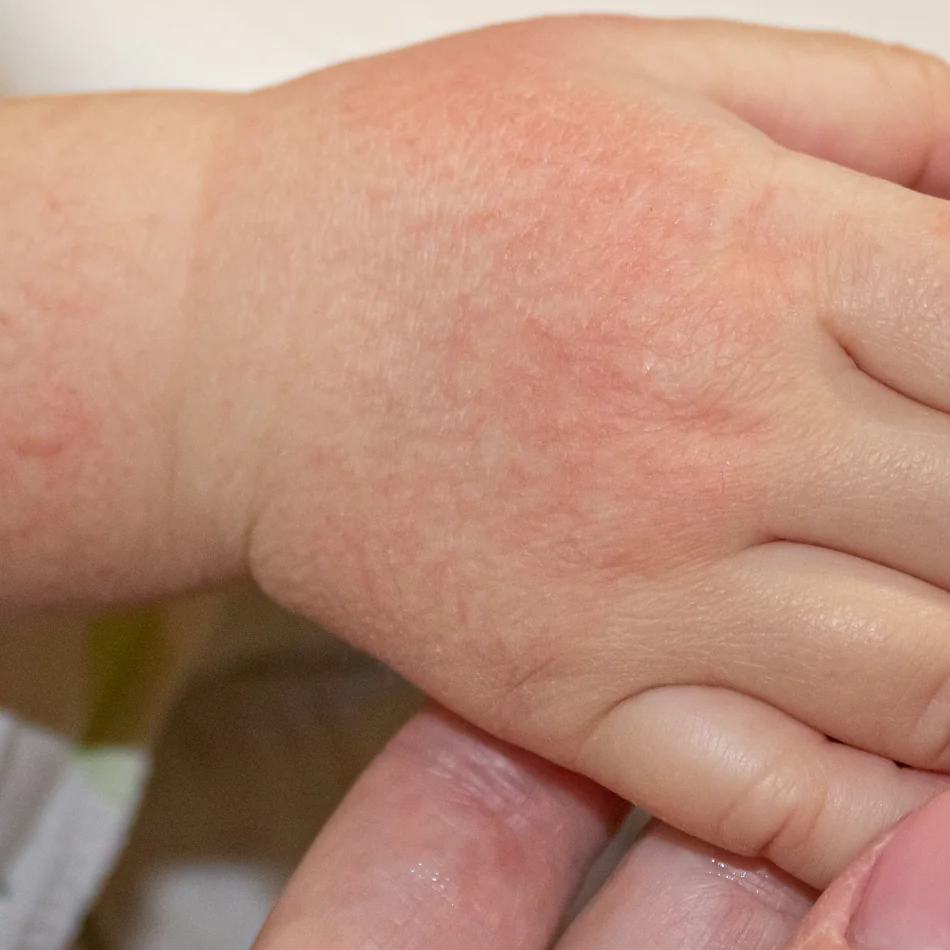 indice de dermatologia