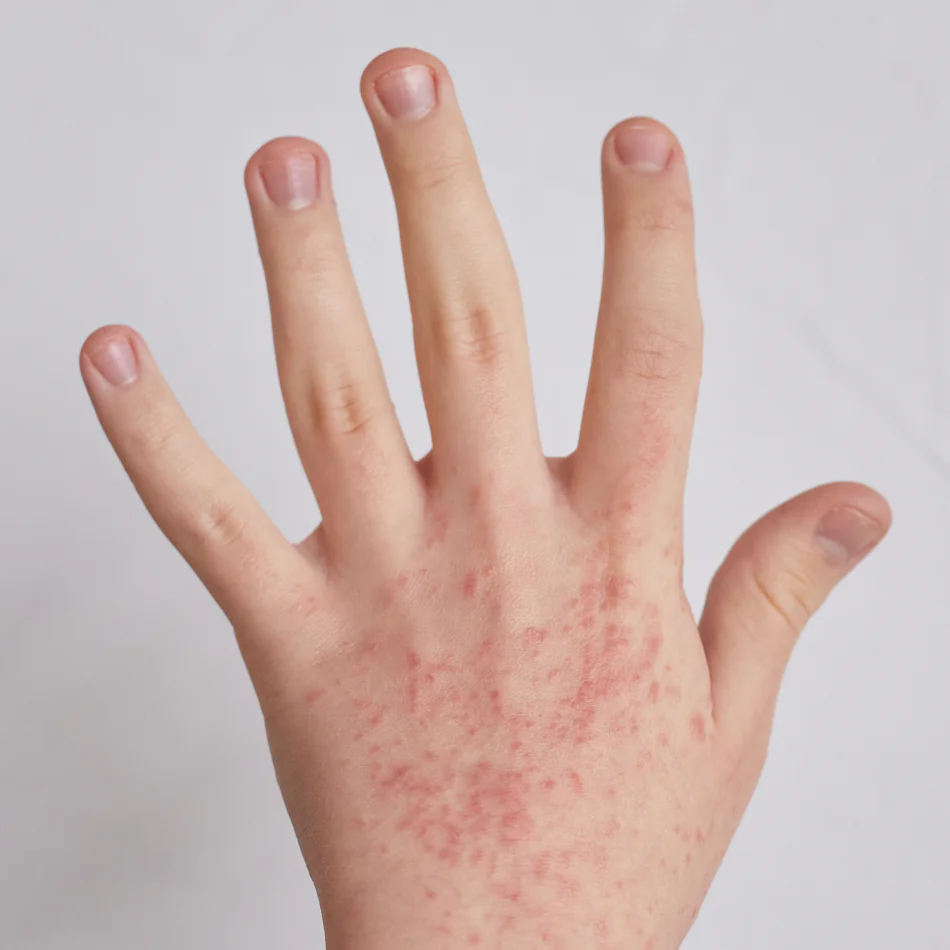 dermatitis por contacto