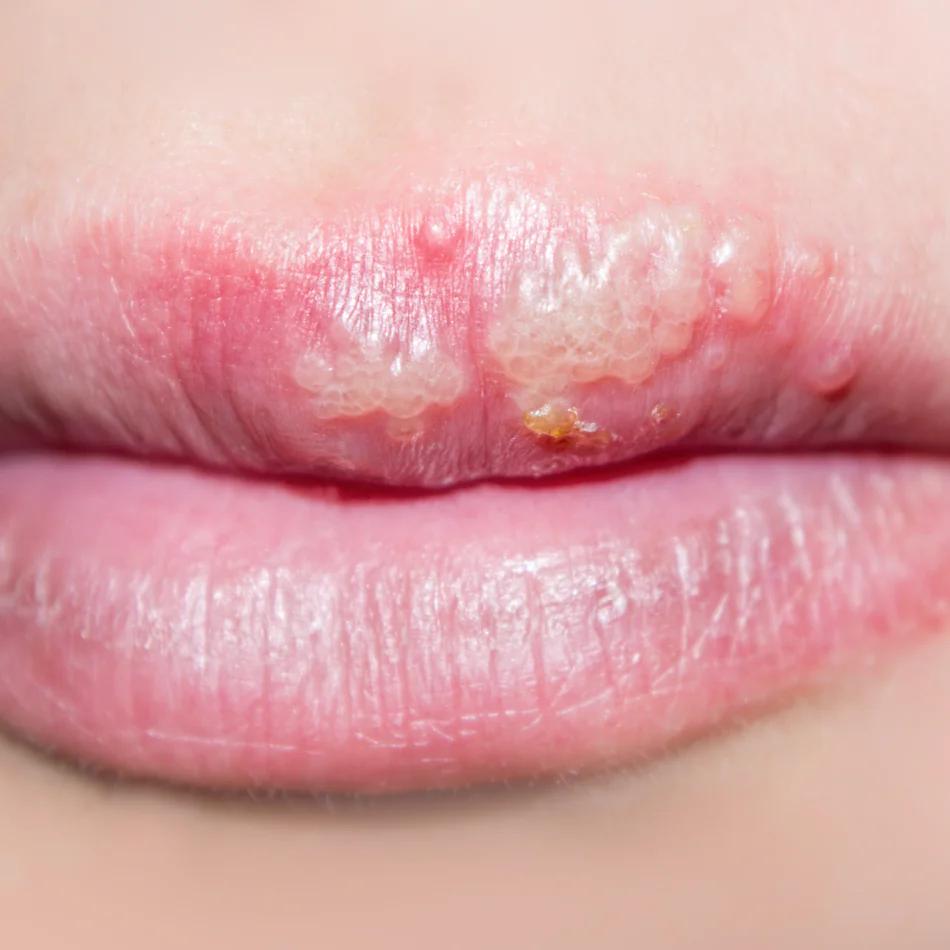 Herpes Labial y Genital