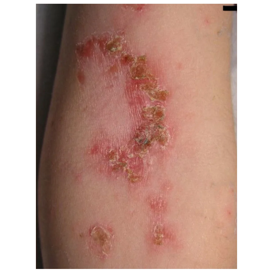 Impetigo
