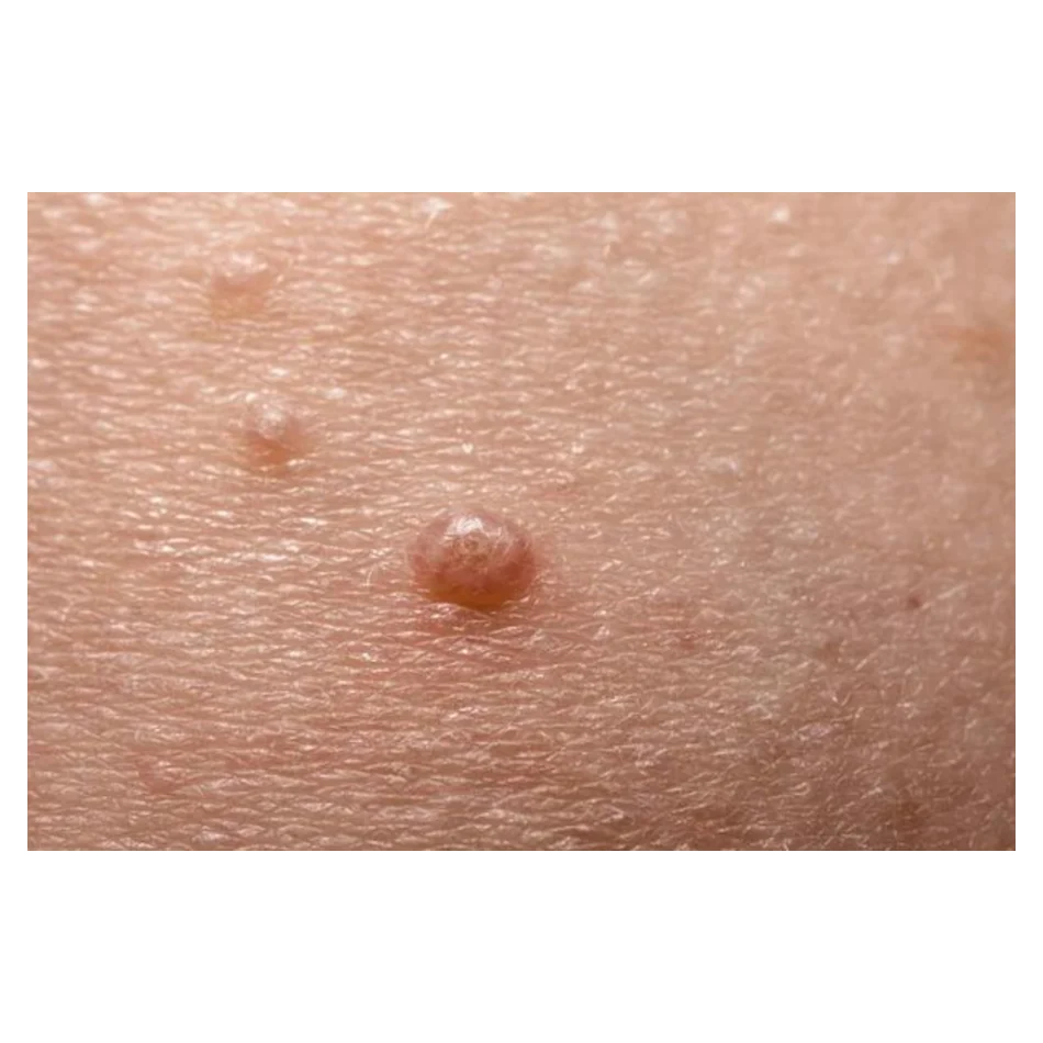 Molluscum Contagiosum: Guía Completa sobre la Infección Viral Cutánea