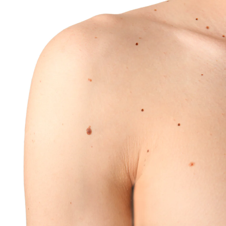 Nevos (Lunares) y Lesiones Pigmentadas: Guía Completa Dermatológica