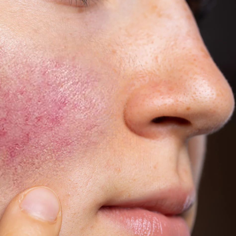 Rosacea