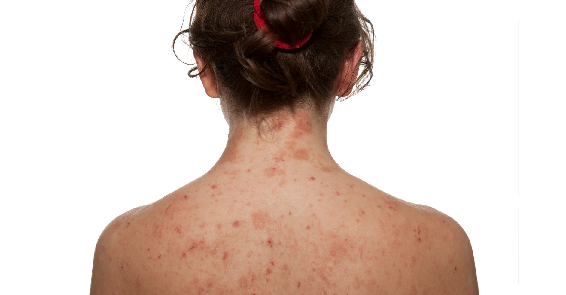 Eliminación de Verrugas Virales en Clínica Estética: Tratamientos Seguros y Eficaces