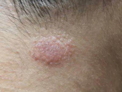 Dermatofitosis