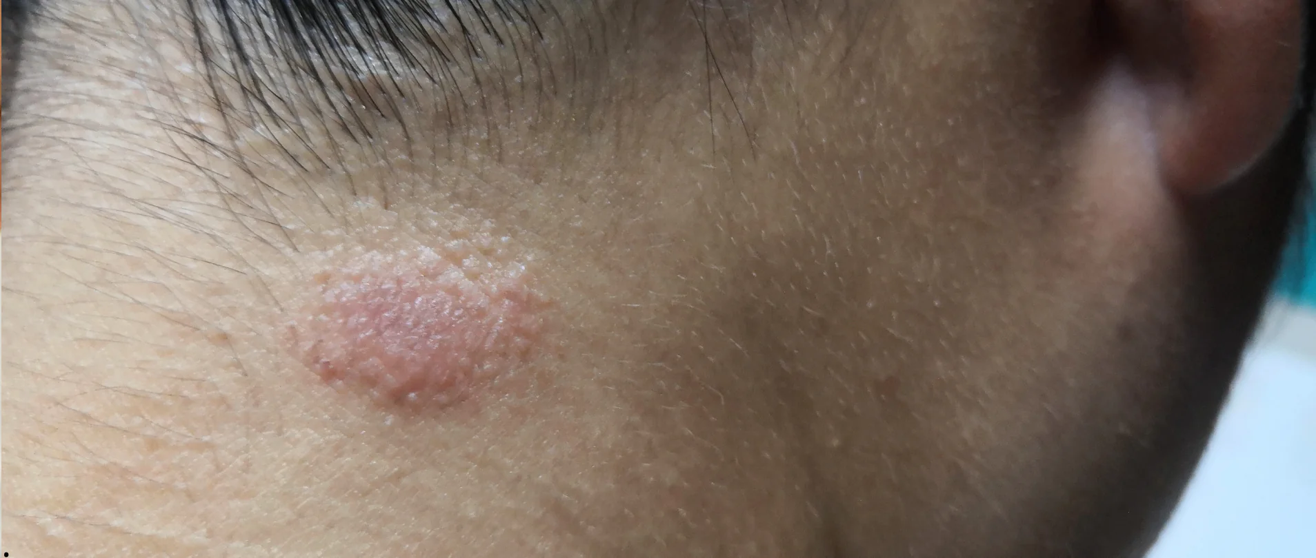 Dermatofitosis: Qué es, causas, síntomas