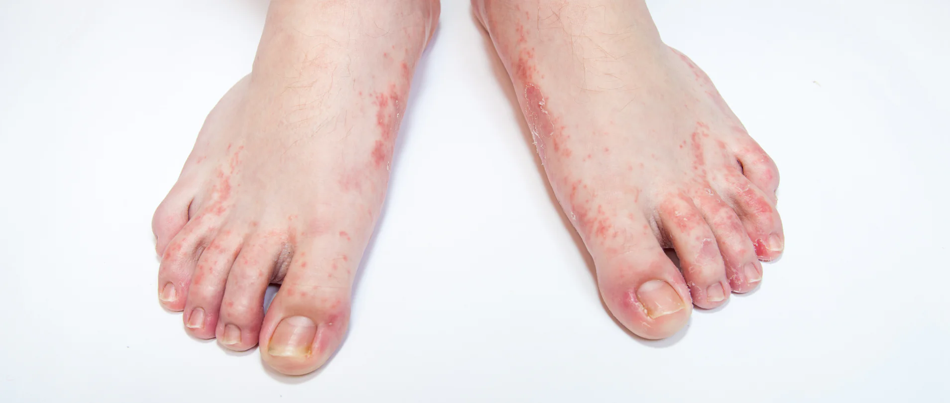 Eliminación de Verrugas Virales en Clínica Estética: Tratamientos Seguros y Eficaces