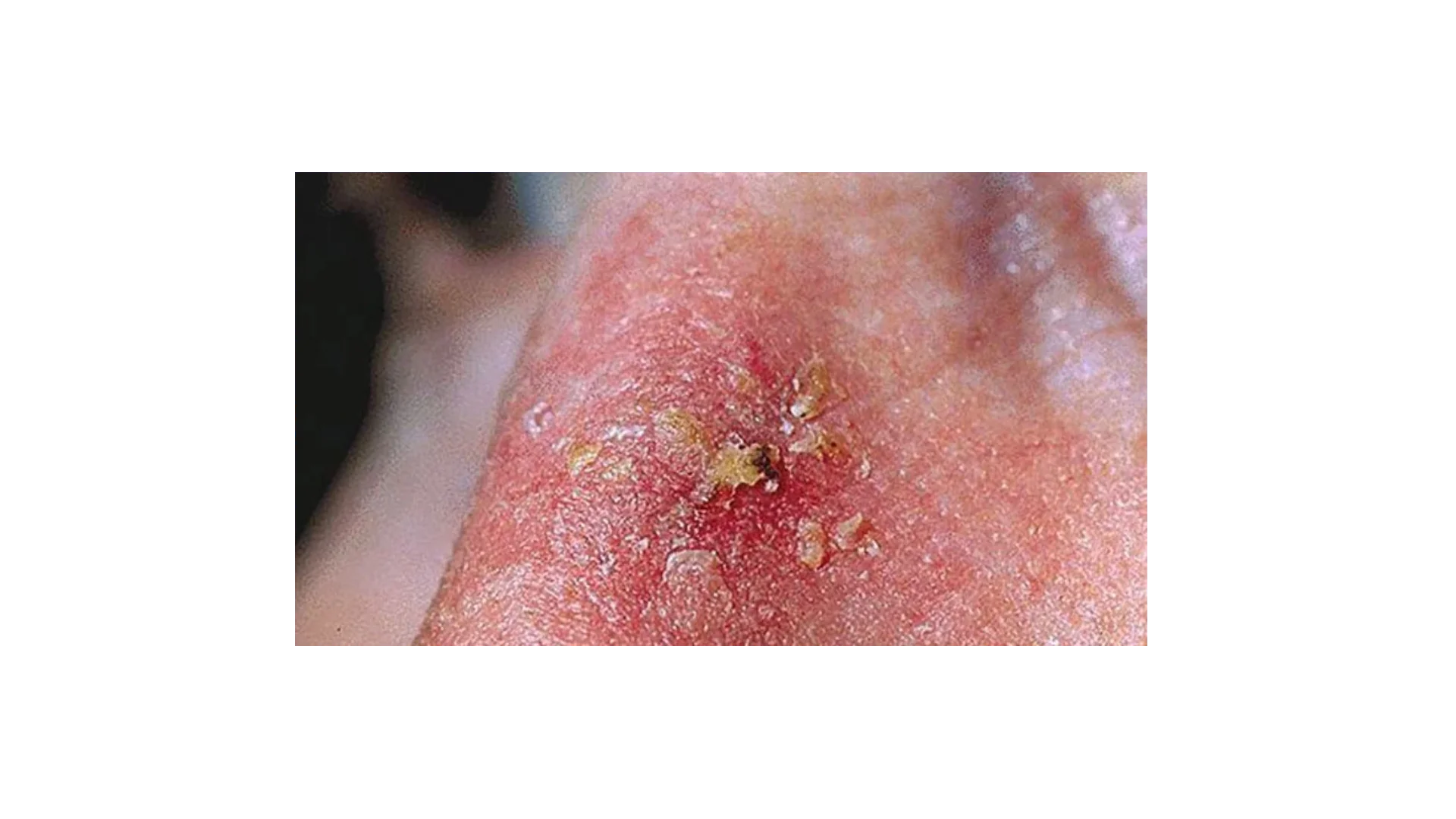 Eliminación de Verrugas Virales en Clínica Estética: Tratamientos Seguros y Eficaces