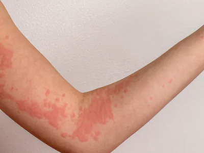 Urticaria Cronica